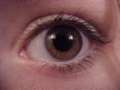 Eyes Disorders