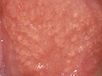 Fordyce Spots