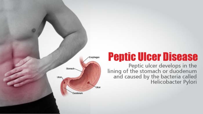 9 Effective Home Remedies For Peptic Ulcer 9 Effective Home Remedies For Peptic Ulcer
